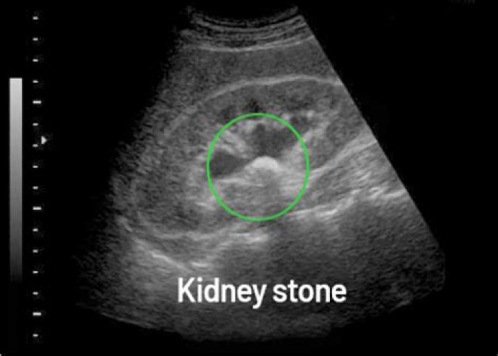 Can kidney calcification be reversed?