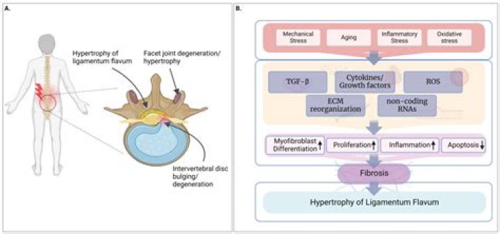 Can ligamentum flavum hypertrophy be reversed?