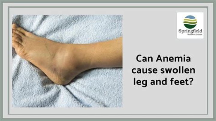 Can low iron cause leg pain?