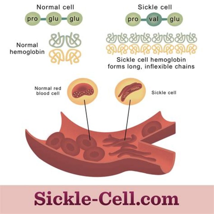 Can low iron cause sickle cell?