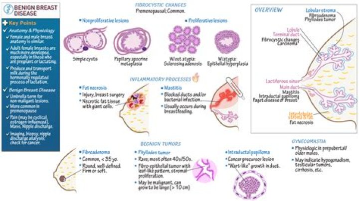 Can malignant breast lump be movable?