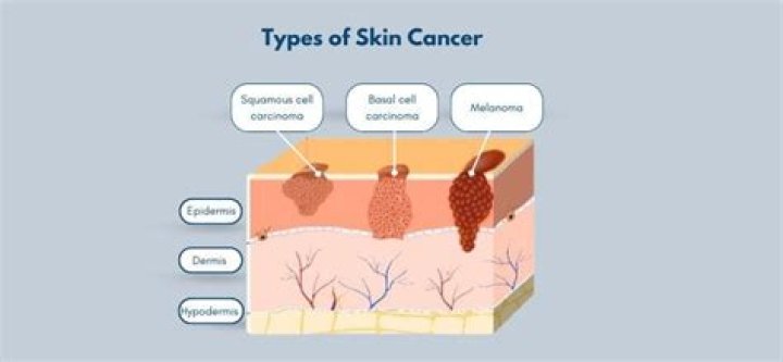Can melanoma be cured?