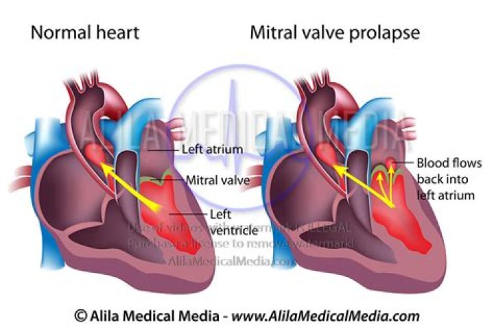Can mitral valve prolapse go away?