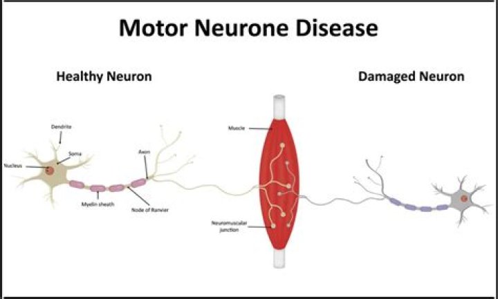 Can motor neurone disease be cured?