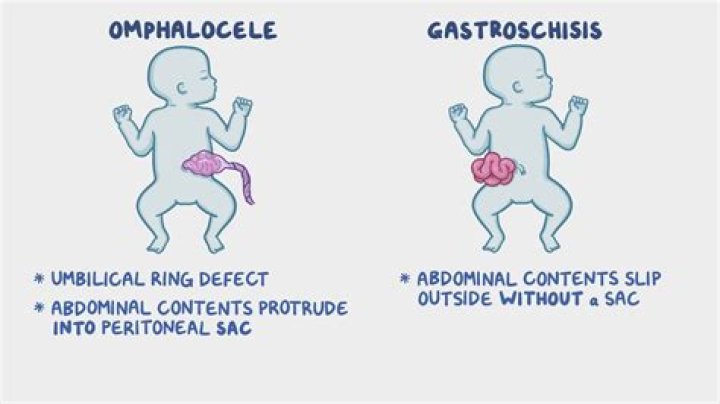 Can omphalocele correct itself?