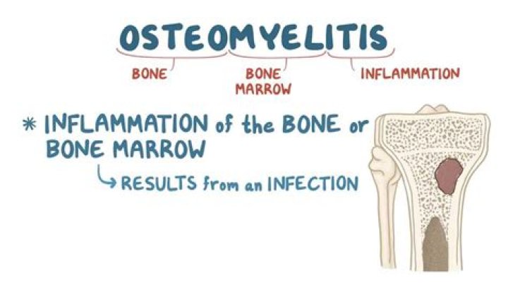 Can osteomyelitis spread to other bones?