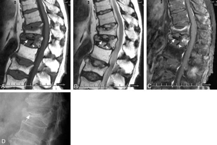 Can osteonecrosis be reversed?