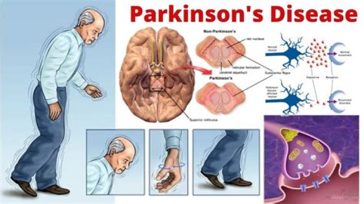 Can parkinson be cured?