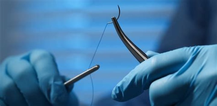 Can perineal stitches tear?