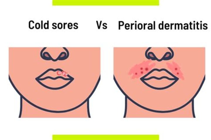 Can perioral dermatitis spread?