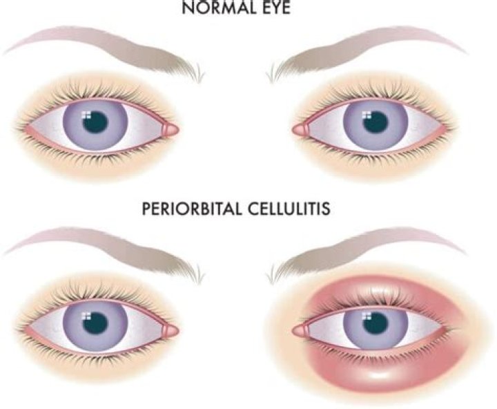 Can periorbital cellulitis become orbital cellulitis?