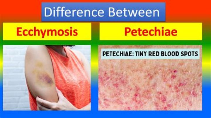 Can petechiae be harmless?