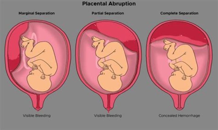 Can placental abruption happen again?