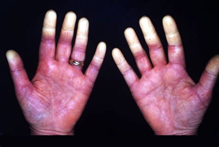 Can raynaud's cause red hands?