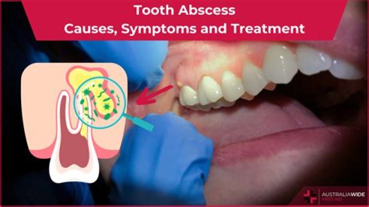 Can rectal abscess heal on its own?