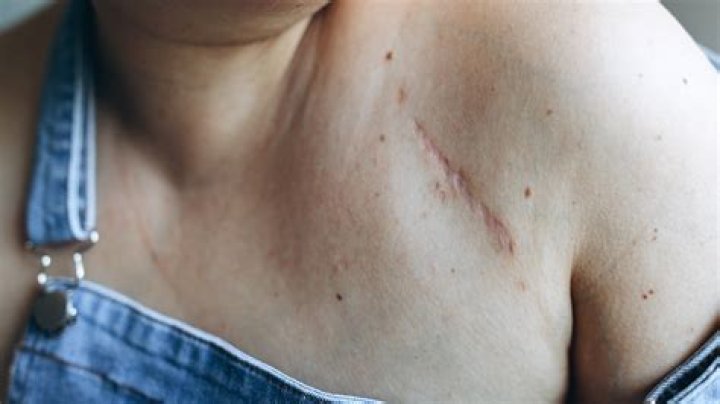 Can scar tissue be mistaken for cancer?