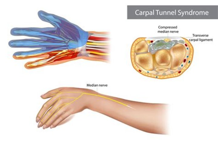Can sewing cause carpal tunnel?