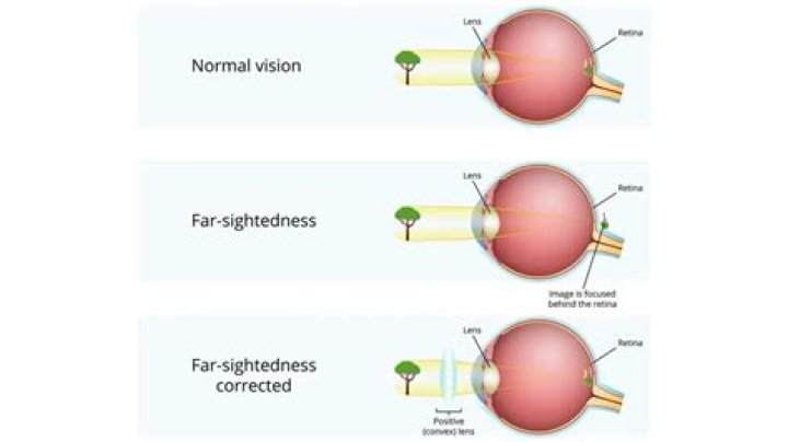 Can short sightedness cause blindness?