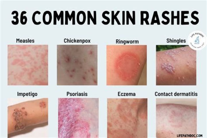Can soaps cause rashes?
