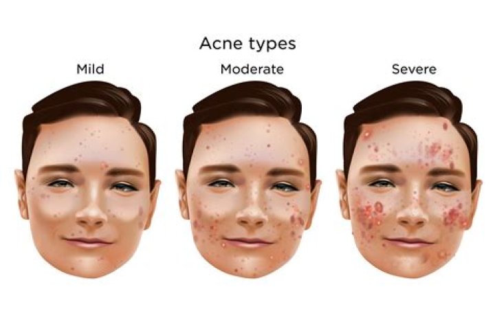 Can spiro make acne worse?