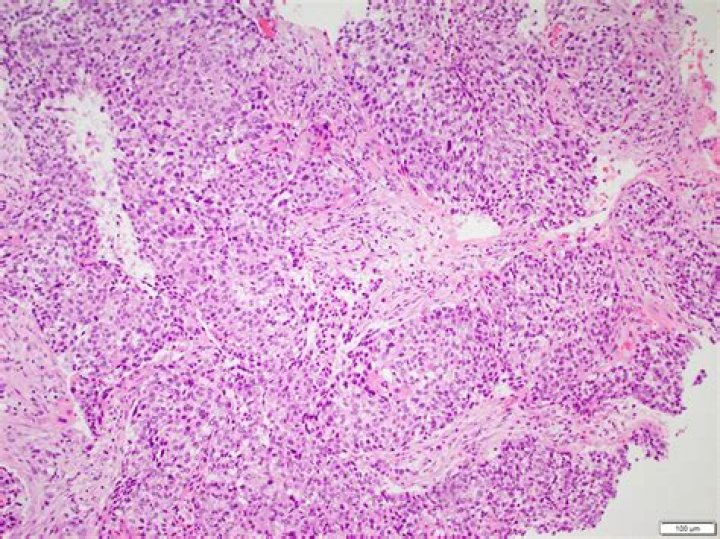 Can squamous cell carcinoma spread to bone?
