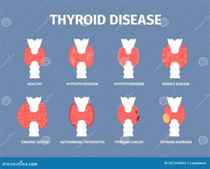Can subacute thyroiditis cause cancer?