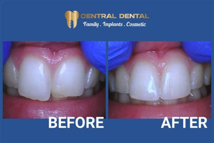 Can teeth be inserted?
