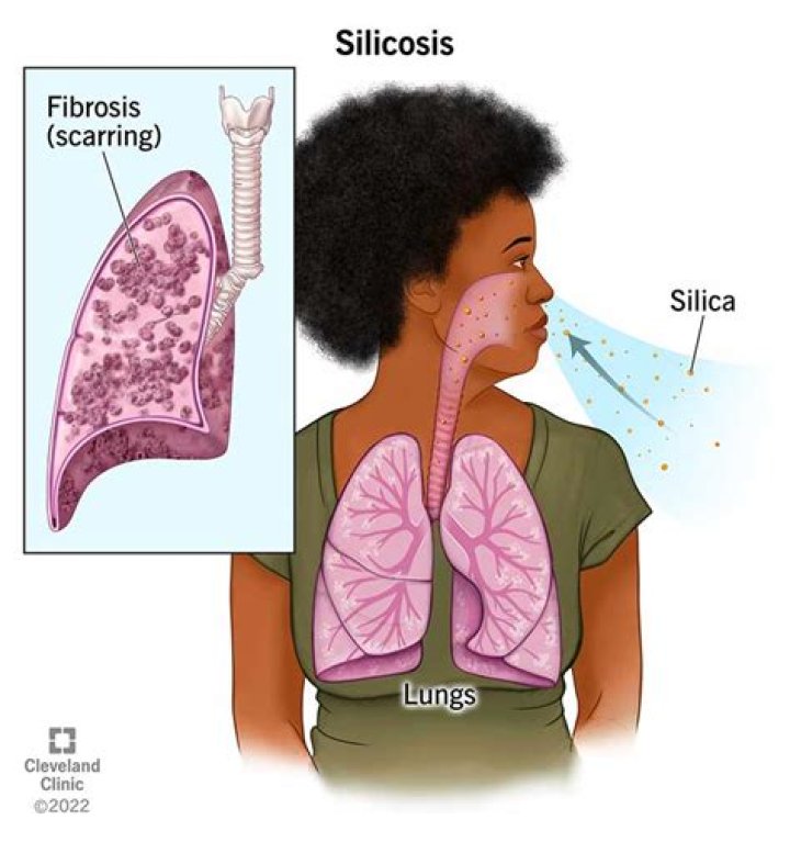 Can tilers get silicosis?