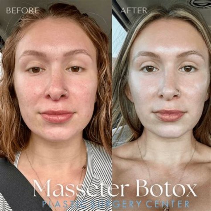 Can u drink after having botox?