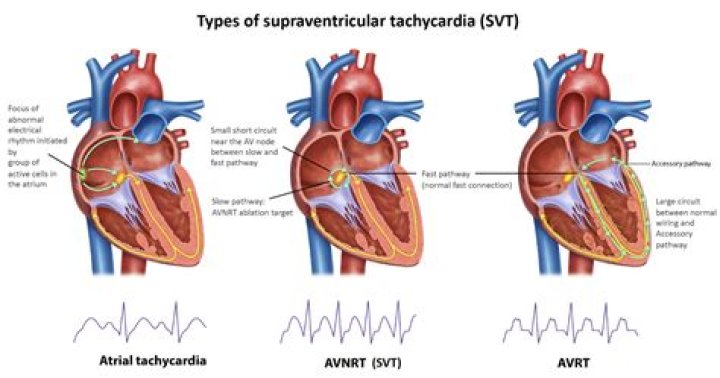 Can ventricular tachycardia be cured?