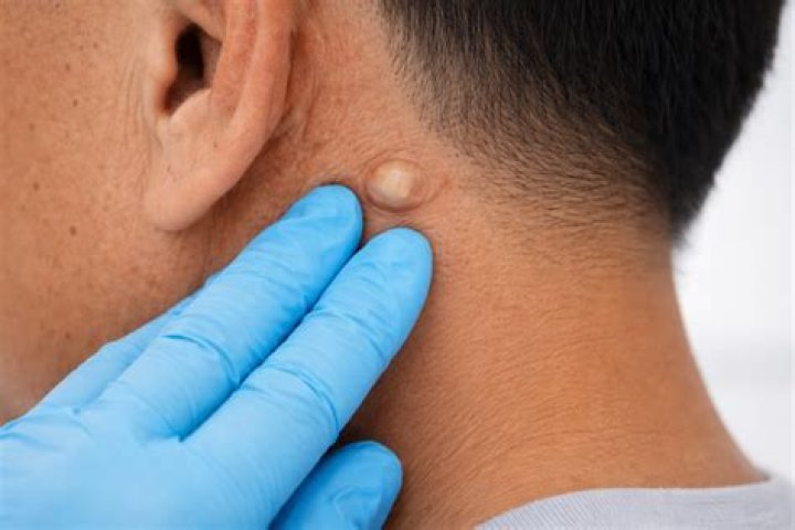 Can wheezing go away on its own?