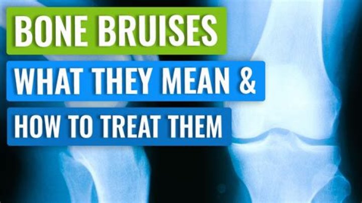 Can you bruise your skull?