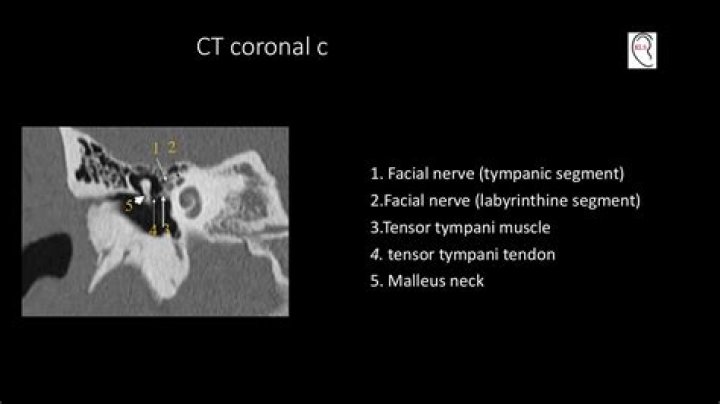 Can you contract the tensor tympani muscle?