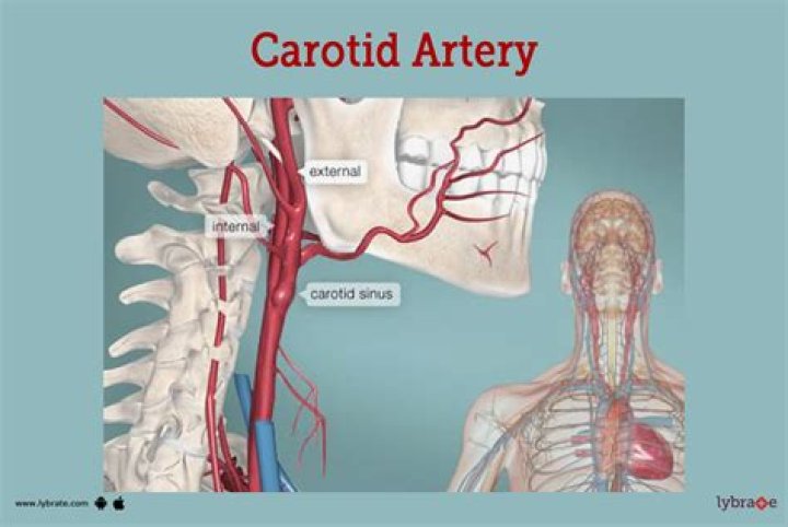 Can you decalcify arteries?