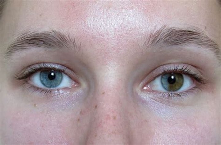Can you develop heterochromia iridis?