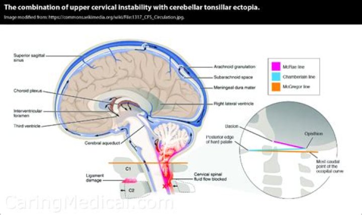 Can you die from cerebellar tonsillar ectopia?