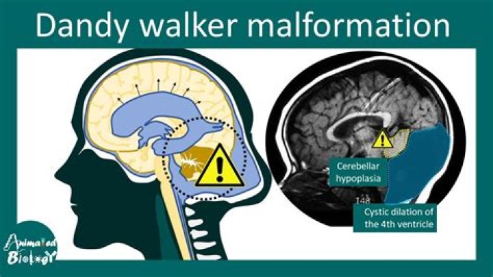 Can you die from gray matter heterotopia?