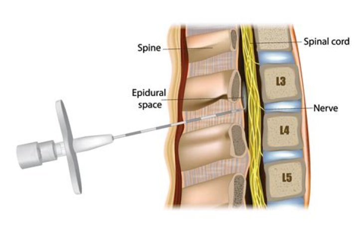 Can you get an epidural at 6 cm?