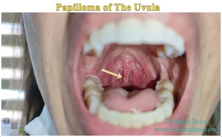 Can you get your uvula removed?