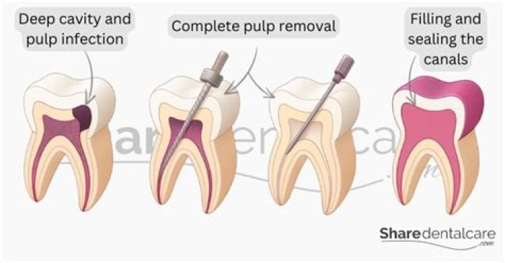Can you have a pulpectomy?