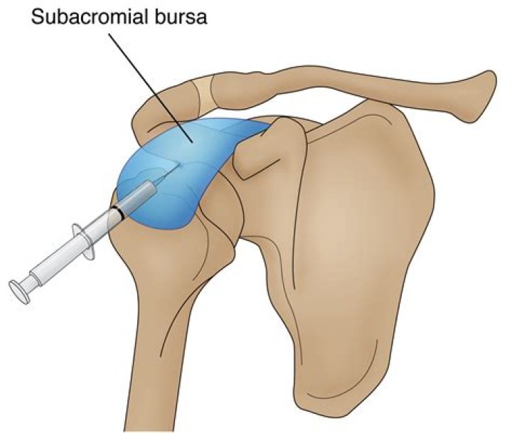 Can you palpate subacromial bursa?
