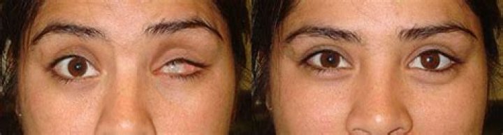 Can you see after enucleation?