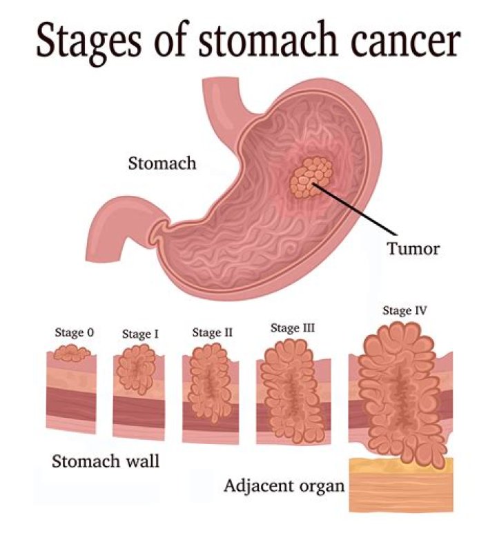 Can you survive adenocarcinoma?