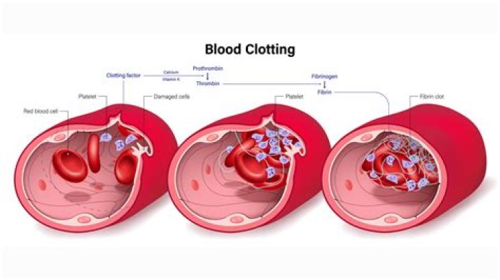 Could a blood clot cause dizziness?