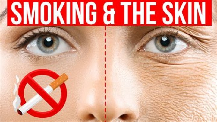 Could cigarettes cause acne?