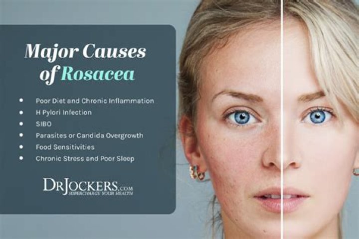 Could digestion cause rosacea?