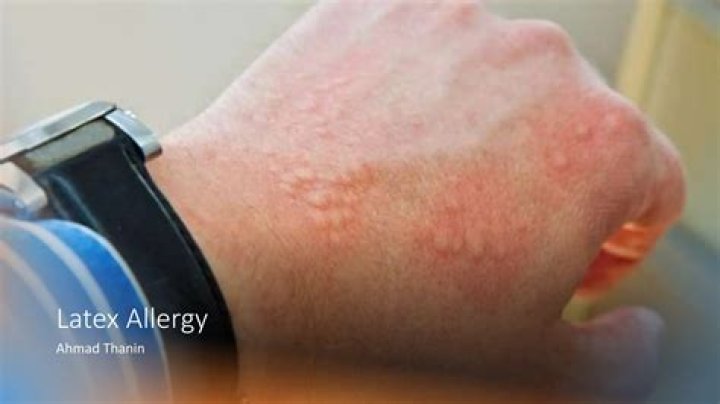 Could i be allergic to niacinamide?