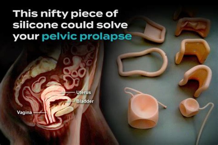 Could i have a prolapse?