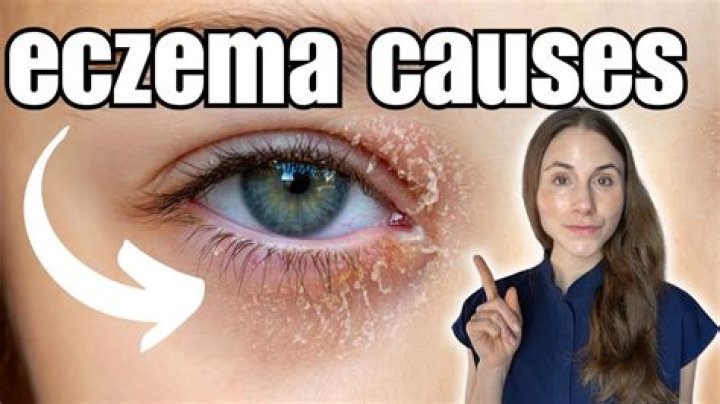 Could i have eczema on my anus?