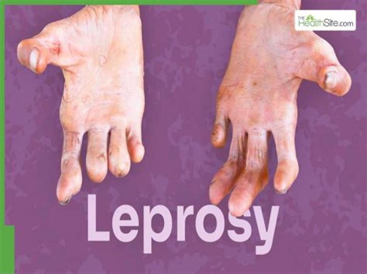 Could i have leprosy?